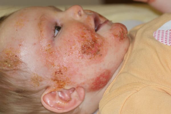 eczéma infecté sur les joues d'un bébé