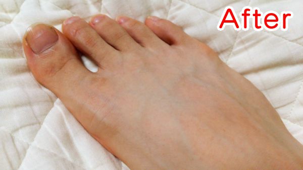 家庭用脱毛器で足の甲を脱毛した脱毛後の写真