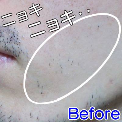 ケノンエステ級の脱毛効果Before