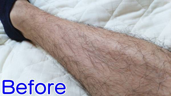 ケノンですね毛を薄くする減毛ビフォー