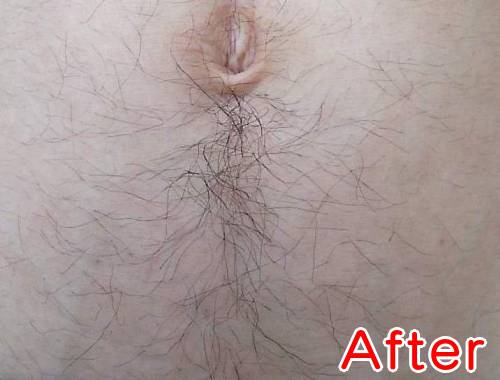 16回照射でこのくらい薄くなる2