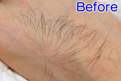 ケノンで濃い足の甲の毛を薄くした1