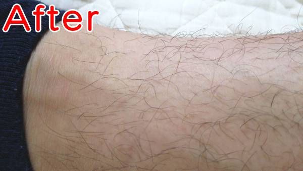 すね毛を薄くする減毛後のアップ