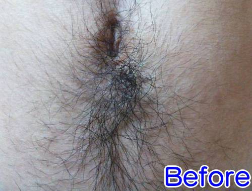 16回照射でこのくらい薄くなる1