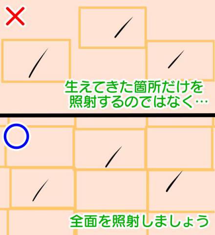 ケノンで濃い毛を薄くするためのやり方のコツ
