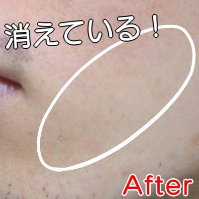 ケノンエステ級の脱毛効果After