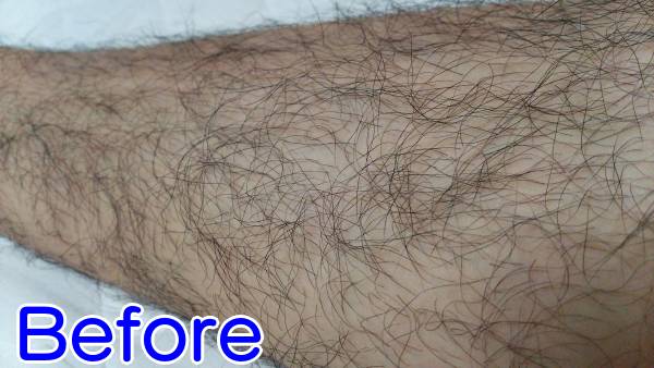 ケノンで濃いすね毛を薄くする前