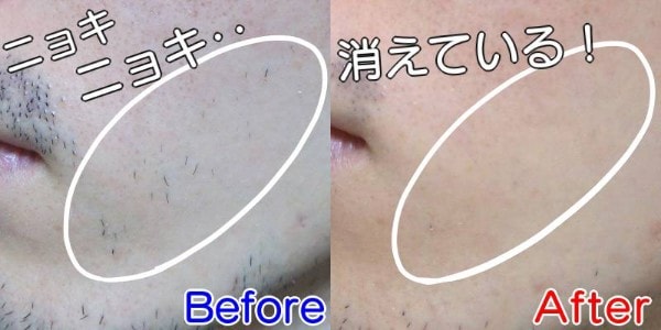 ケノンを他脱毛器と比較 優れている点8つ と 劣っている点1つ ケノン買って2年が経ちました