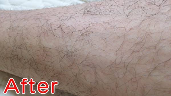 ケノンで濃いすね毛を薄くした後