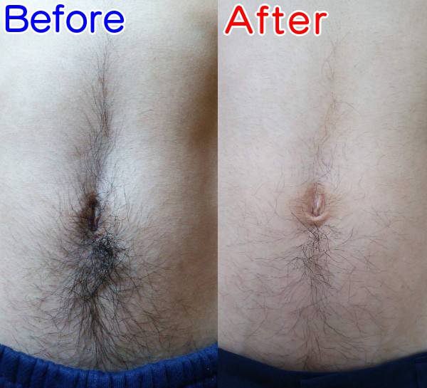 濃い腹毛を薄くする減毛ビフォーアフター
