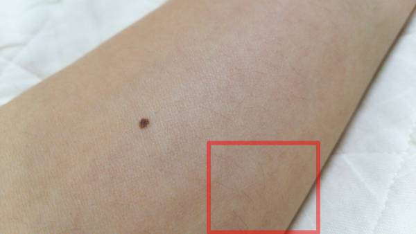 ケノンで腕の産毛脱毛前