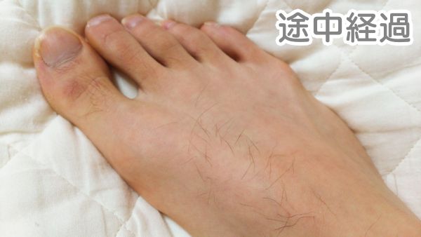 家庭用脱毛器で足の甲を脱毛した途中経過の写真