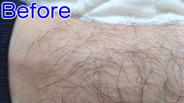 すね毛を薄くする減毛前のアップ