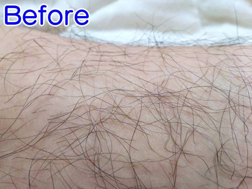 7回照射でこのくらい減毛する1