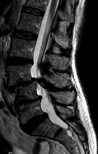 Spinalkanalstenose Hws Bws Lws Neurochirurgie Wirbelsaulenchirurgie Koln Siegburg