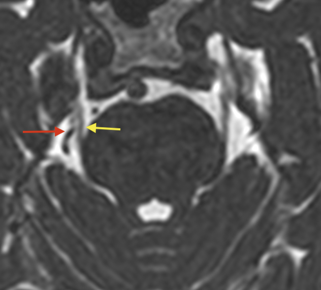 Trigeminusneuralgie - Wirbelsäulenchirurgie Köln Siegburg