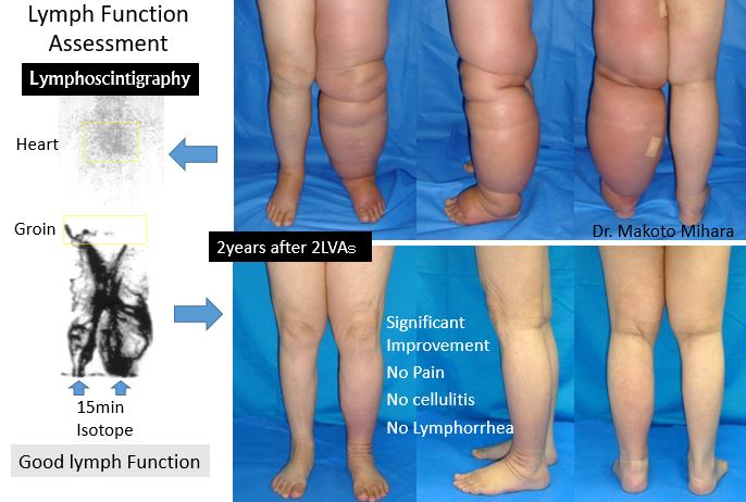 Cases Cellulitis Pain Mominoki Day Surgery Clinic In Japan