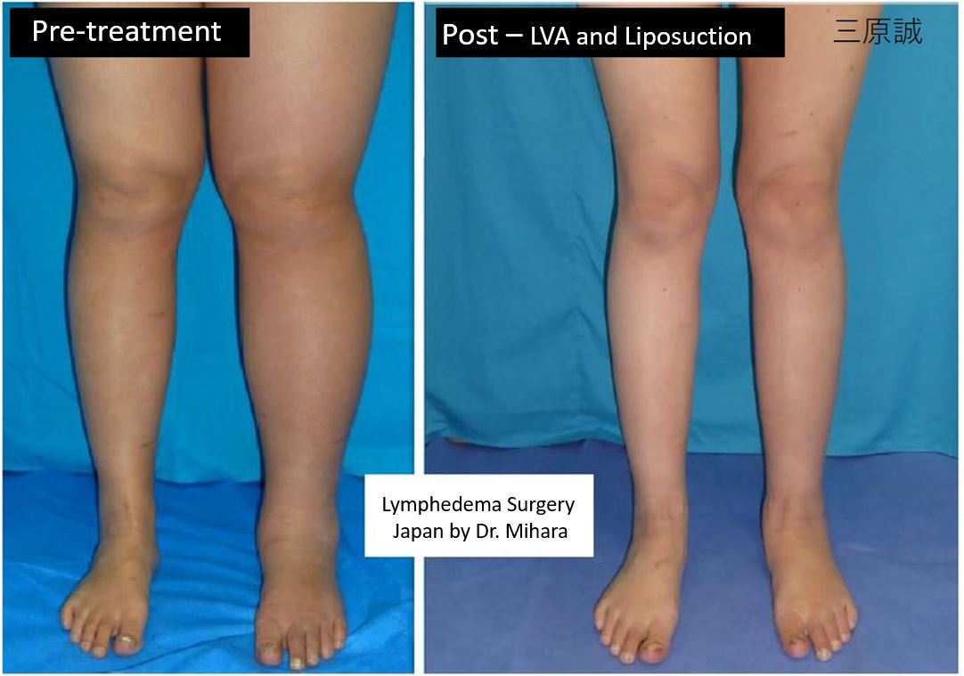 Lymphedema Liposuction, Lymphedema Treament Japan, Makaoto Mihara