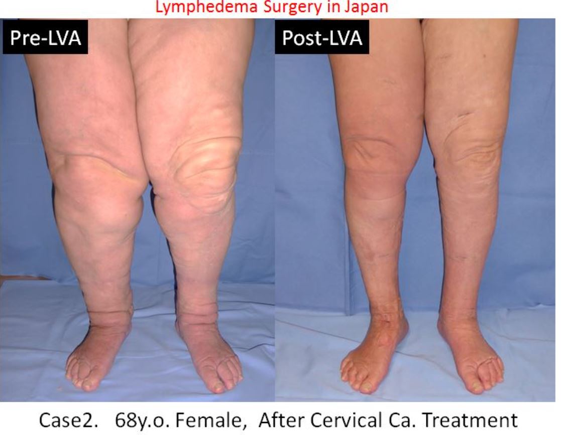 Bilateral Lower limb lymphedema, Lymphedema Treatment Japan