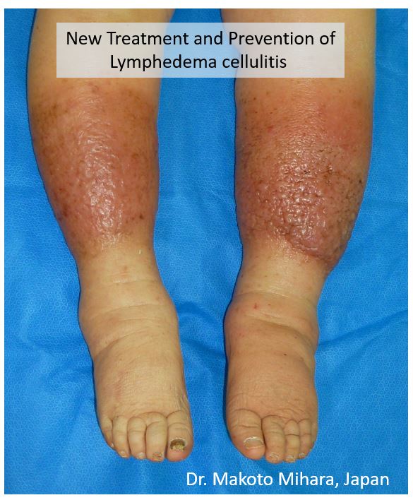 Lower limb lymphedema, cellulitis, lymphorrhea, Lymphedema Treatment Japan