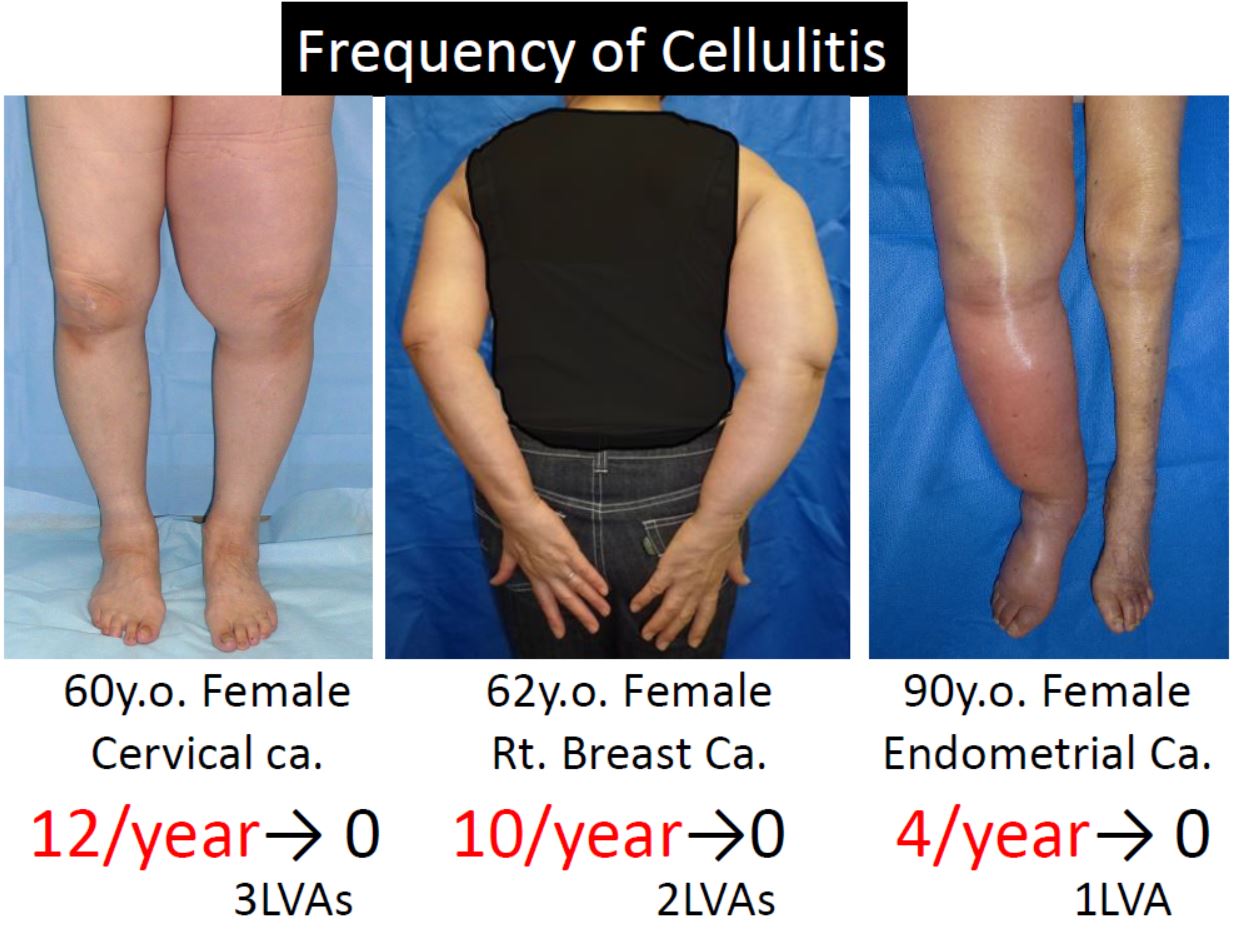 Cellulitis treatment and prevention Mominoki Day Surgery Clinic