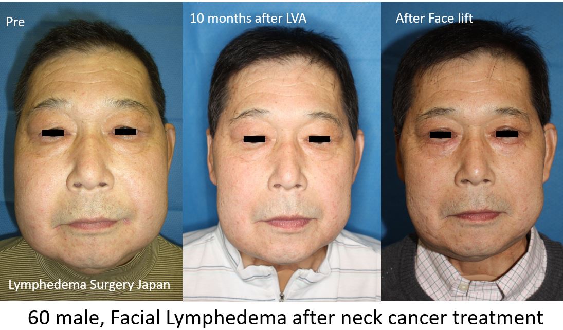 Cases, Cellulitis, Pain - Mominoki Day Surgery Clinic in Japan