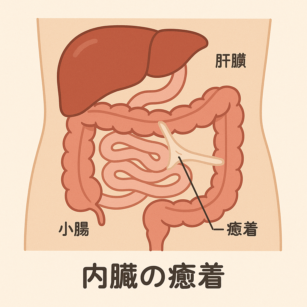 内臓の癒着による不調について