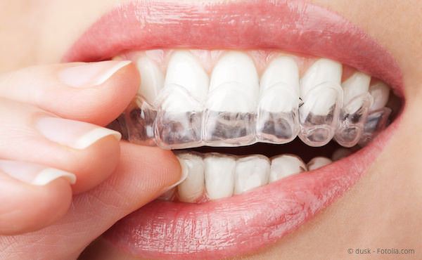 Aligner Invisalign durchsichtige Schiene