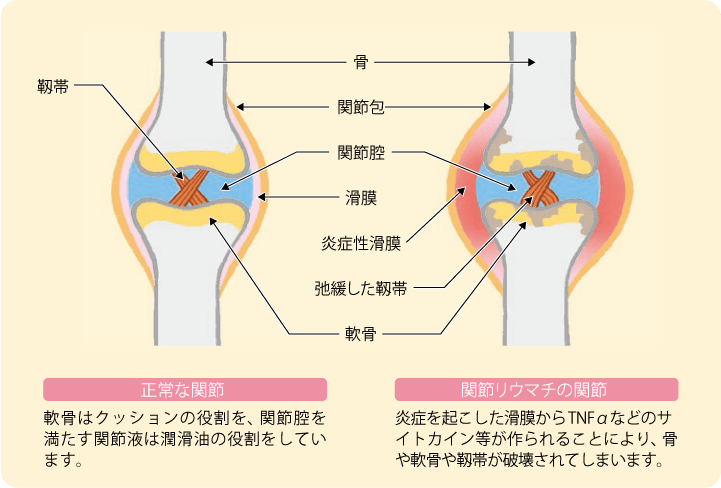 関節リウマチの関節