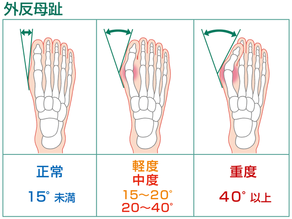 外反母趾イラスト