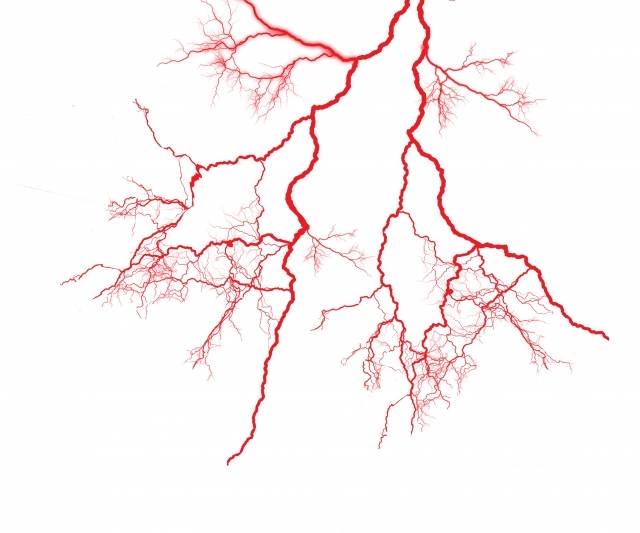 モヤモヤ血管の画像