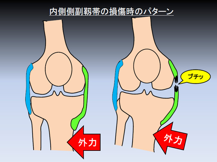 膝内側側副靭帯損傷