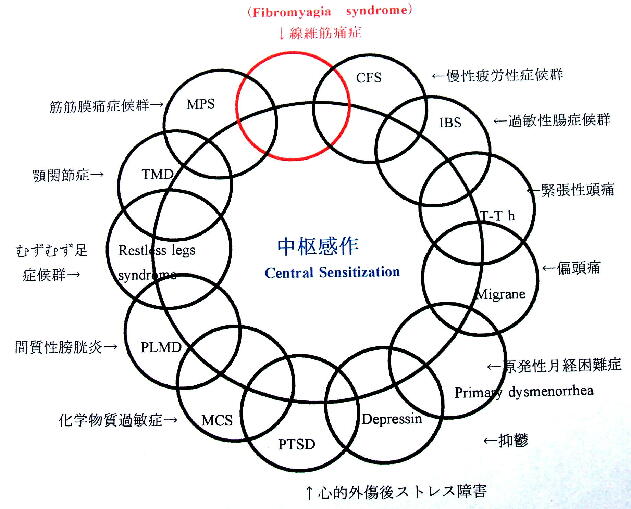 中枢感作