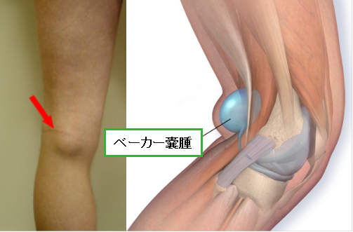 ベーカー嚢腫