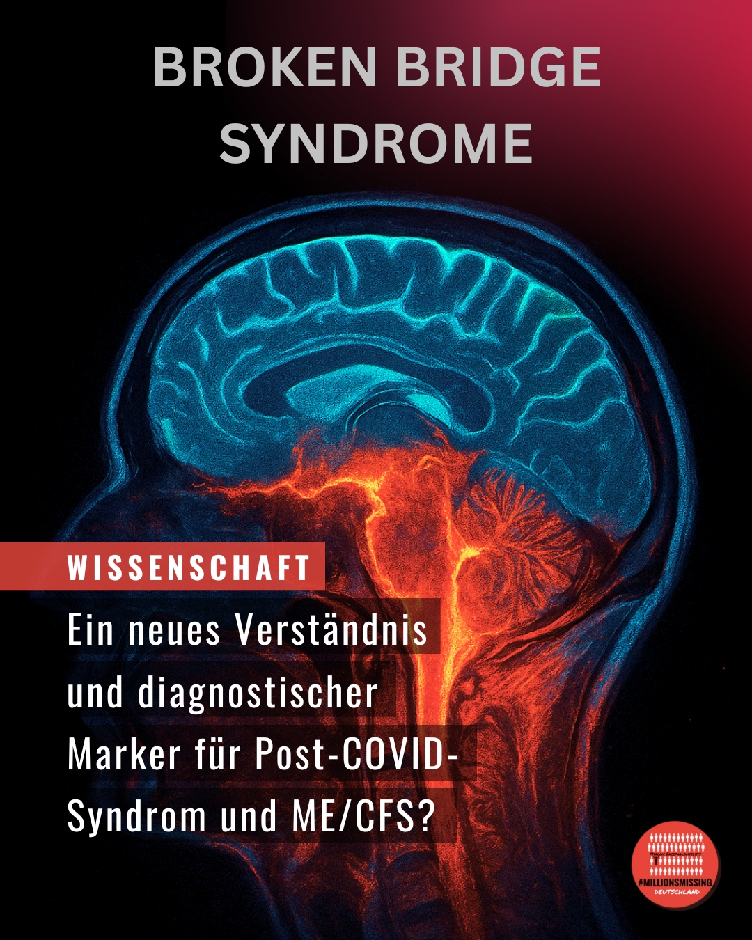 Broken Bridge Syndrome: Ein neues Verständnis und diagnostischer Marker für das Post-COVID-Syndrom (PCS) und ME/CFS?