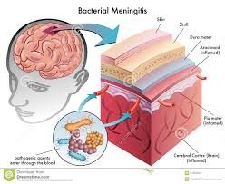 meningitis, encefalitis, nasajpg.com, infectologia, medicina interna