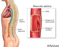 Disección aortica