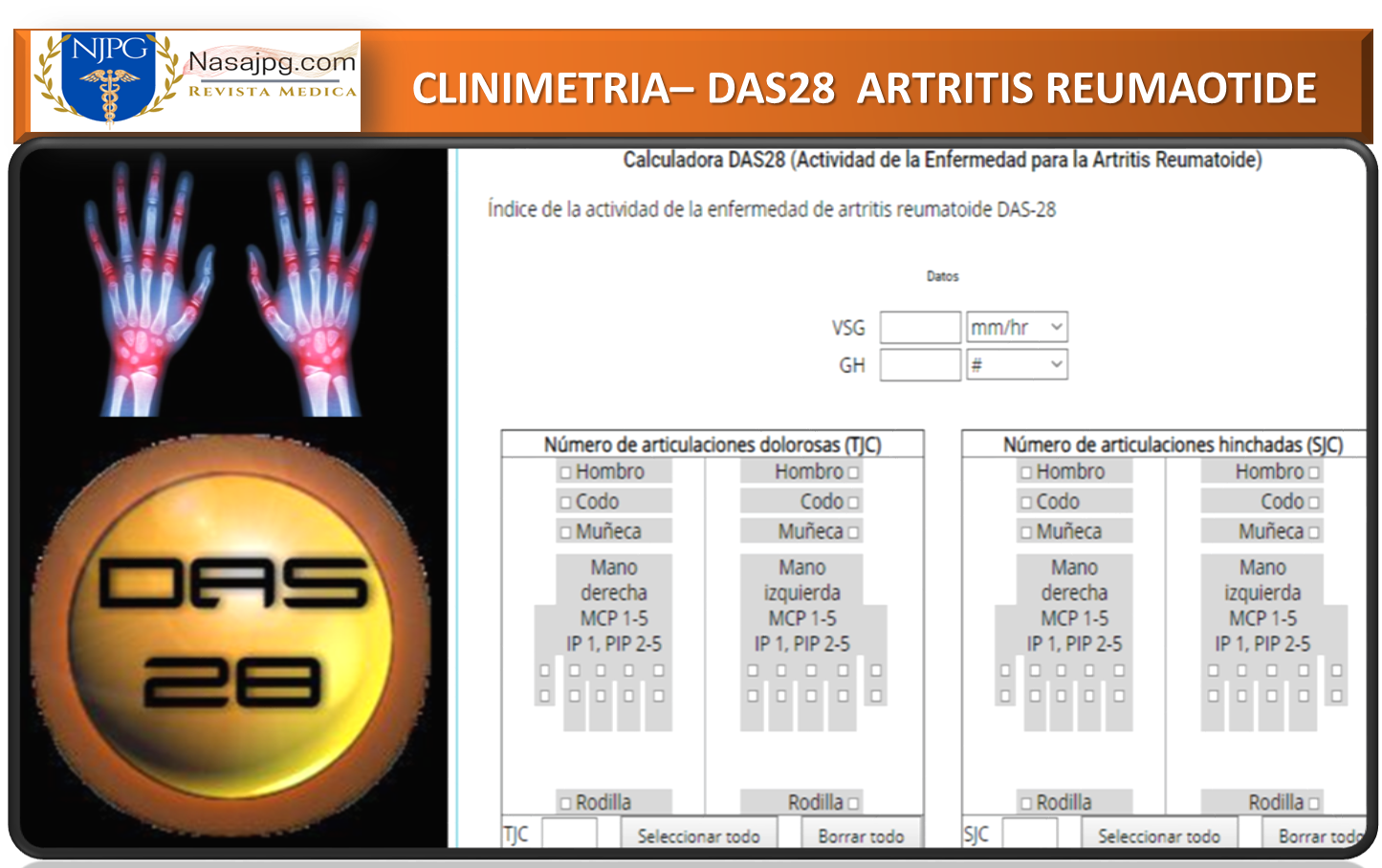 Calculadora DAS28 (Actividad de la Enfermedad para la Artritis Reumatoide)