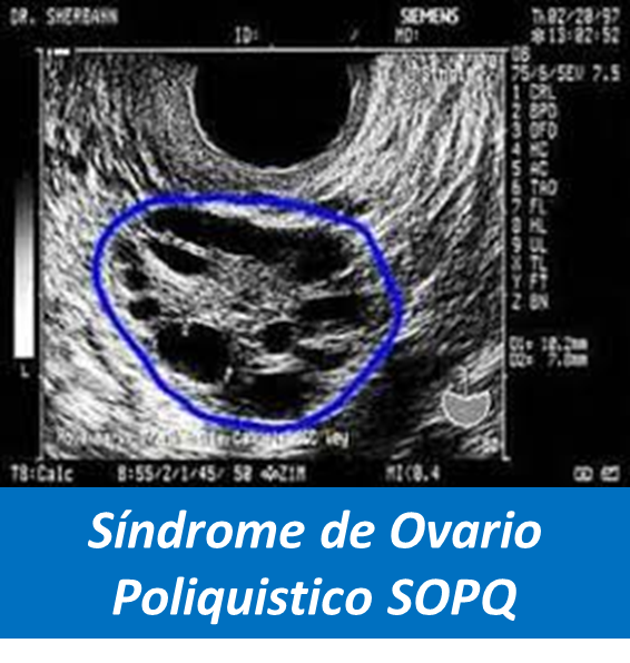 Síndrome de Ovario Poliquistico, Manejo del Síndrome de Ovario Poliquistico, SOPQ