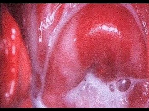 La vagina en nacidos
