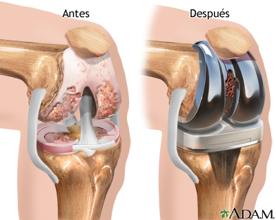 Simulador Medico de Cirugia de Reemplazo de rodilla en Ortopedia