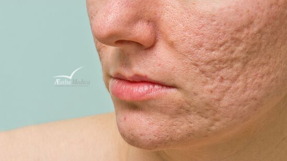 laser per cicatrici da acne