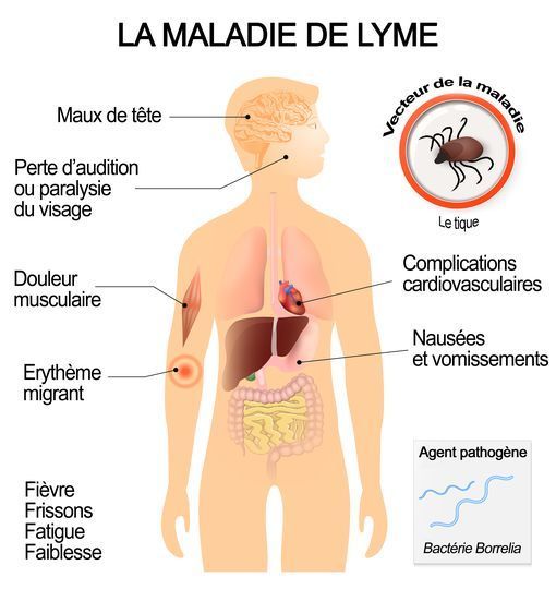 symptomes-de-la-maladie-de-lyme