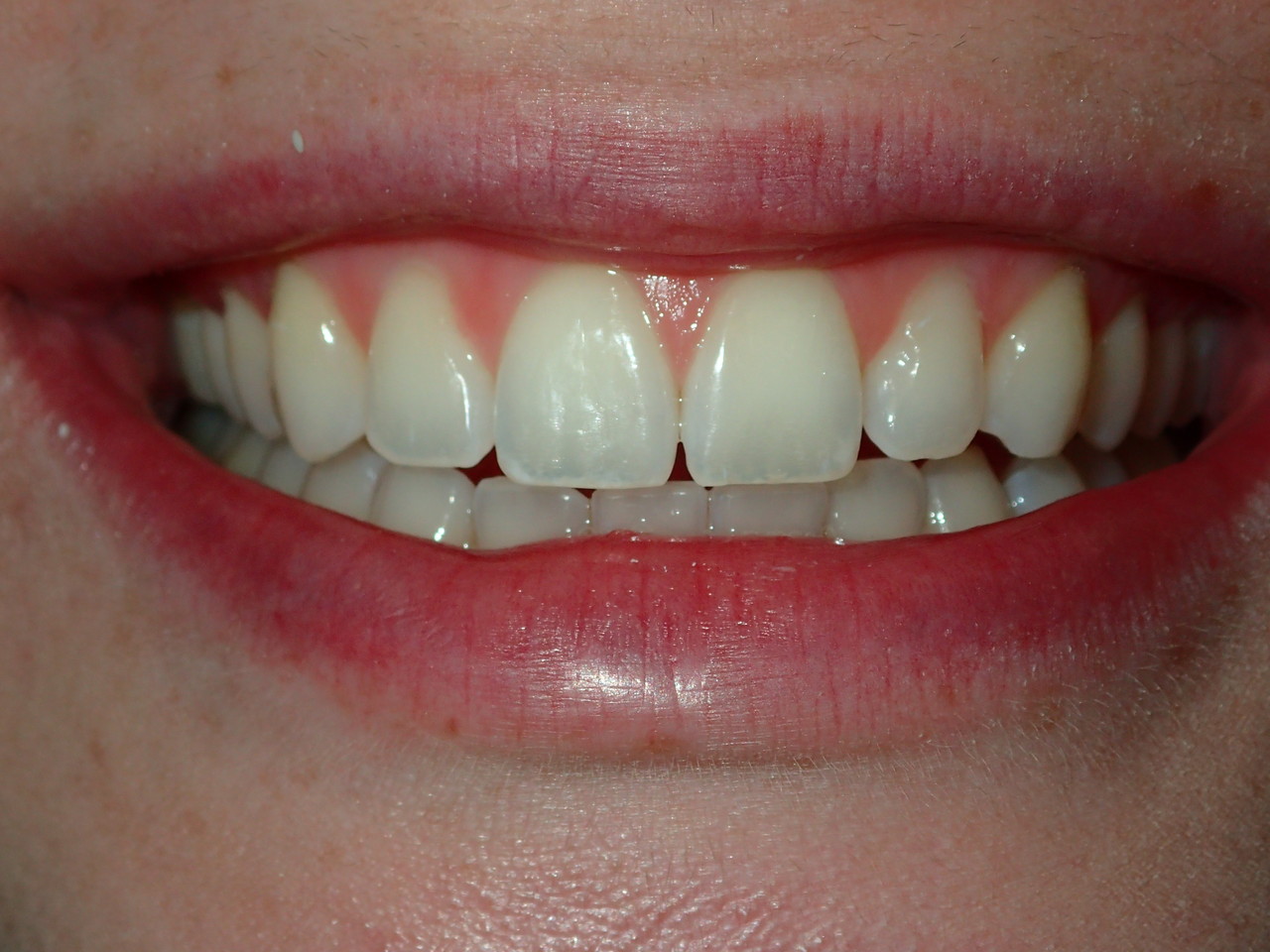 What Are No Prep Veneers Strong Family Dentistry Spanish Fork