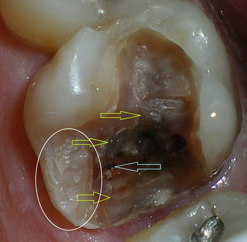 Do I really need a root canal? - Strong Family Dentistry ...