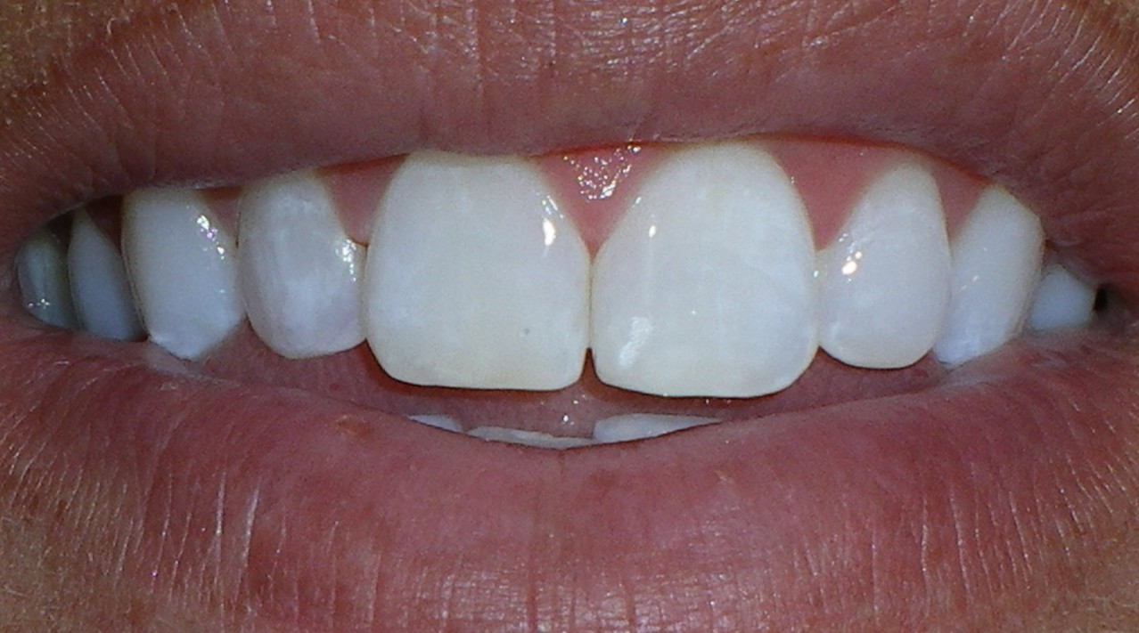 White Fillings Strong Family Dentistry Spanish Fork