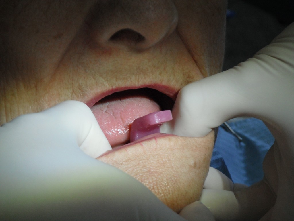 Toma De Impresion Definitiva En Protesis Fija cursoprotesis.jimdofree.com