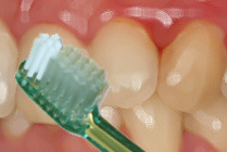 Brossage des dents et saignement des gencives © ParoSphère
