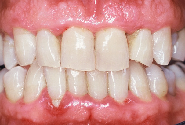 Trous noirs entre les dents, gencive rouge et début de déchaussement sur l'incisive en bas à gauche sur l'image.