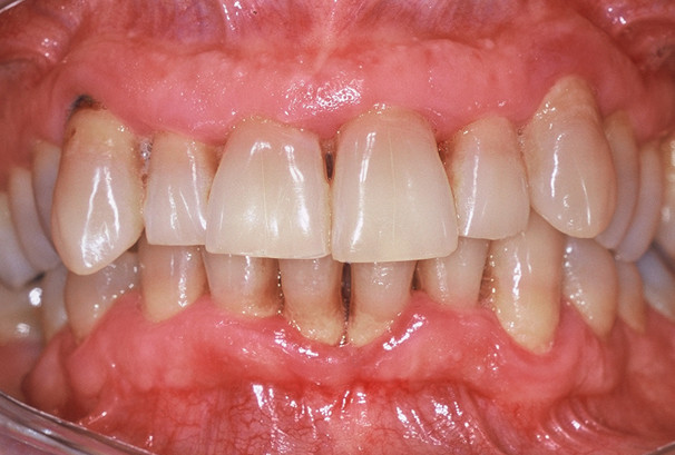 Des trous noirs apparaissent entre les dents; les dents du bas se déchaussent.